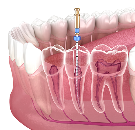 3D render showing the process of a tooth being drilled for a root canal treatment.